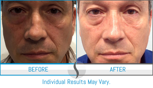 Before & After - Spa Blue Skin Care & Laser Center Orlando, FL Before & After - Spa Blue Skin Care & Laser Center Orlando, FL