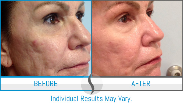 Before & After - Spa Blue Skin Care & Laser Center Orlando, FL Before & After - Spa Blue Skin Care & Laser Center Orlando, FL