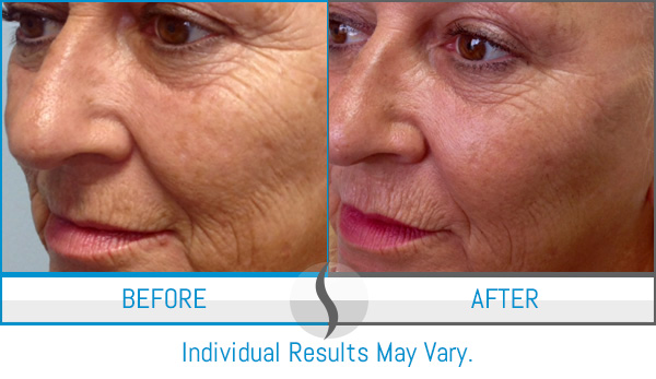 Before & After - Spa Blue Skin Care & Laser Center Orlando, FL Before & After - Spa Blue Skin Care & Laser Center Orlando, FL