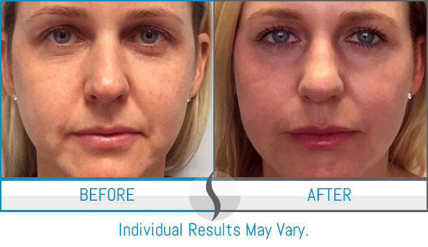Before & After - Spa Blue Skin Care & Laser Center Orlando, FL Before & After - Spa Blue Skin Care & Laser Center Orlando, FL