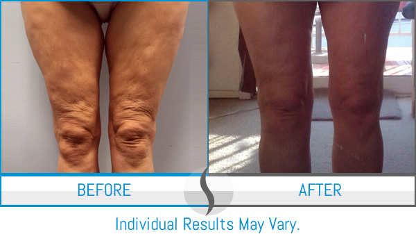 Before & After - Spa Blue Skin Care & Laser Center Orlando, FL Before & After - Spa Blue Skin Care & Laser Center Orlando, FL