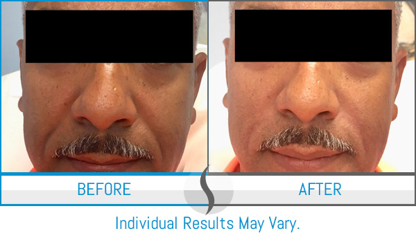 Before & After - Spa Blue Skin Care & Laser Center Orlando, FL Before & After - Spa Blue Skin Care & Laser Center Orlando, FL