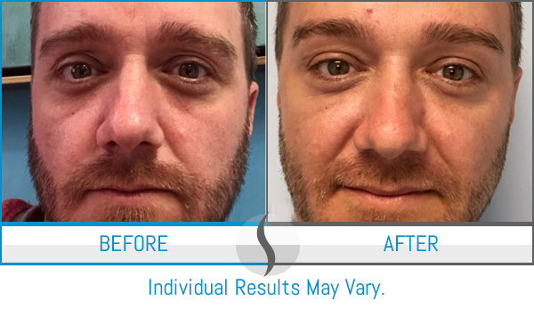 Before & After - Spa Blue Skin Care & Laser Center Orlando, FL Before & After - Spa Blue Skin Care & Laser Center Orlando, FL