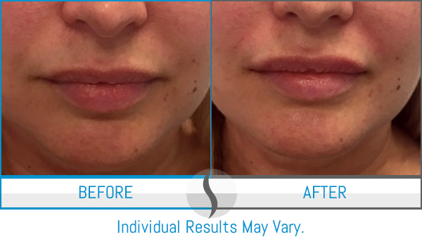 Before & After - Spa Blue Skin Care & Laser Center Orlando, FL Before & After - Spa Blue Skin Care & Laser Center Orlando, FL
