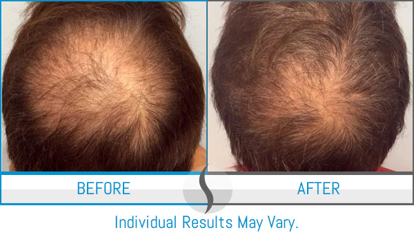 Before & After - Spa Blue Skin Care & Laser Center Orlando, FL Before & After - Spa Blue Skin Care & Laser Center Orlando, FL