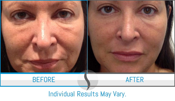 Before & After - Spa Blue Skin Care & Laser Center Orlando, FL Before & After - Spa Blue Skin Care & Laser Center Orlando, FL
