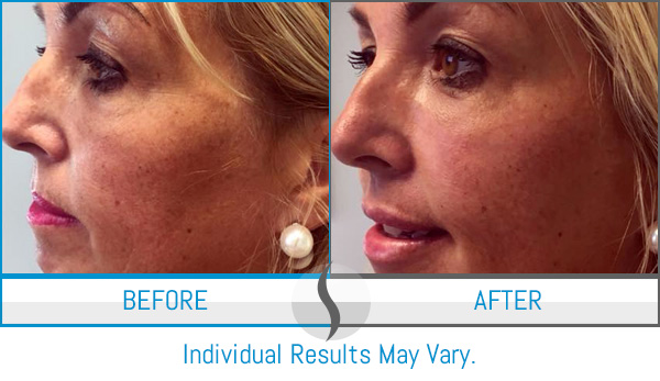 Before & After - Spa Blue Skin Care & Laser Center Orlando, FL Before & After - Spa Blue Skin Care & Laser Center Orlando, FL