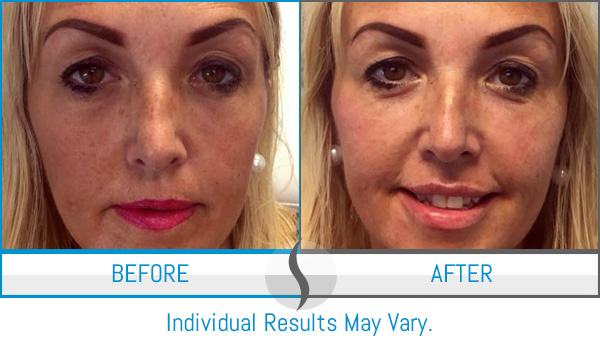 Before & After - Spa Blue Skin Care & Laser Center Orlando, FL Before & After - Spa Blue Skin Care & Laser Center Orlando, FL