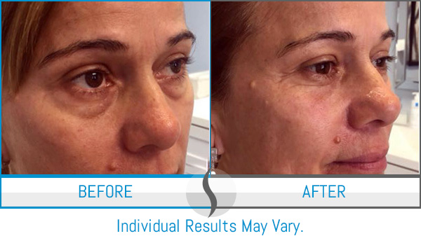 Before & After - Spa Blue Skin Care & Laser Center Orlando, FL Before & After - Spa Blue Skin Care & Laser Center Orlando, FL