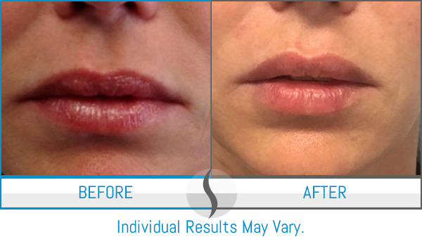 Before & After - Spa Blue Skin Care & Laser Center Orlando, FL Before & After - Spa Blue Skin Care & Laser Center Orlando, FL