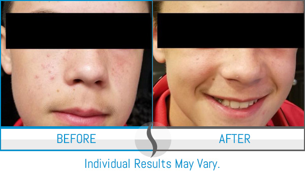 Before & After - Spa Blue Skin Care & Laser Center Orlando, FL Before & After - Spa Blue Skin Care & Laser Center Orlando, FL