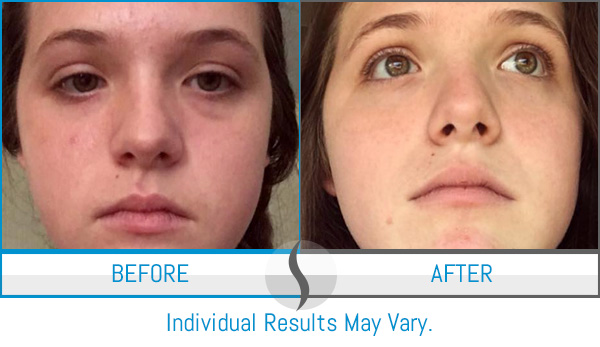 Before & After - Spa Blue Skin Care & Laser Center Orlando, FL Before & After - Spa Blue Skin Care & Laser Center Orlando, FL