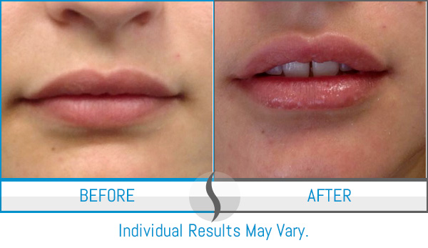 Before & After - Spa Blue Skin Care & Laser Center Orlando, FL Before & After - Spa Blue Skin Care & Laser Center Orlando, FL