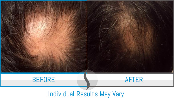 Before & After - Spa Blue Skin Care & Laser Center Orlando, FL Before & After - Spa Blue Skin Care & Laser Center Orlando, FL