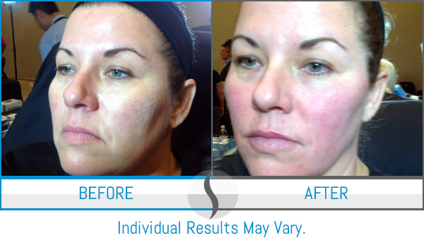 Before & After - Spa Blue Skin Care & Laser Center Orlando, FL Before & After - Spa Blue Skin Care & Laser Center Orlando, FL