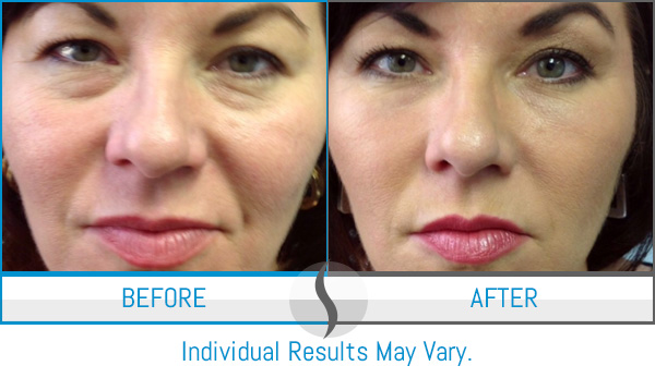 Before & After - Spa Blue Skin Care & Laser Center Orlando, FL Before & After - Spa Blue Skin Care & Laser Center Orlando, FL