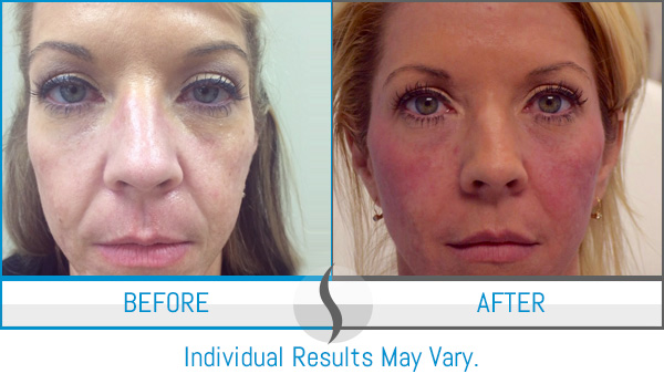 Before & After - Spa Blue Skin Care & Laser Center Orlando, FL Before & After - Spa Blue Skin Care & Laser Center Orlando, FL