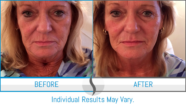 Before & After - Spa Blue Skin Care & Laser Center Orlando, FL Before & After - Spa Blue Skin Care & Laser Center Orlando, FL