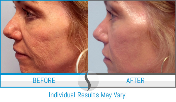 Before & After - Spa Blue Skin Care & Laser Center Orlando, FL Before & After - Spa Blue Skin Care & Laser Center Orlando, FL