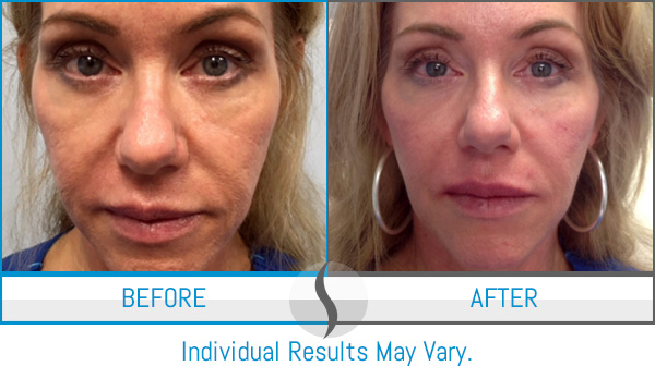 Before & After - Spa Blue Skin Care & Laser Center Orlando, FL Before & After - Spa Blue Skin Care & Laser Center Orlando, FL