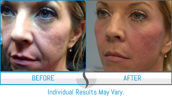 Before & After - Spa Blue Skin Care & Laser Center Orlando, FL Before & After - Spa Blue Skin Care & Laser Center Orlando, FL