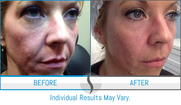 Before & After - Spa Blue Skin Care & Laser Center Orlando, FL Before & After - Spa Blue Skin Care & Laser Center Orlando, FL