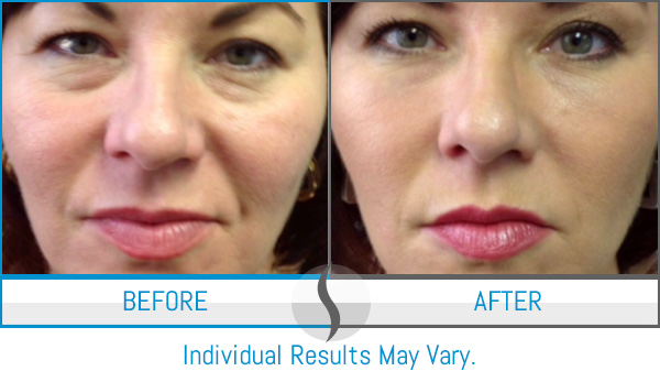 Before & After - Spa Blue Skin Care & Laser Center Orlando, FL Before & After - Spa Blue Skin Care & Laser Center Orlando, FL