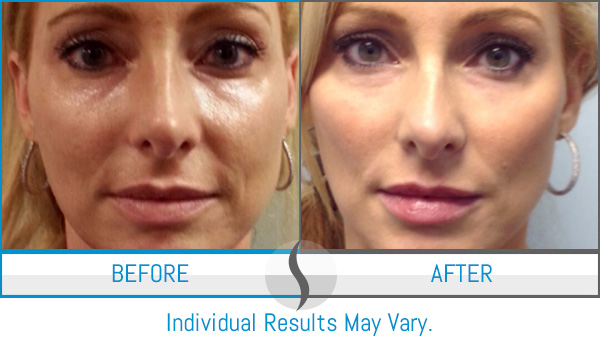 Before & After - Spa Blue Skin Care & Laser Center Orlando, FL Before & After - Spa Blue Skin Care & Laser Center Orlando, FL