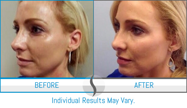 Before & After - Spa Blue Skin Care & Laser Center Orlando, FL Before & After - Spa Blue Skin Care & Laser Center Orlando, FL