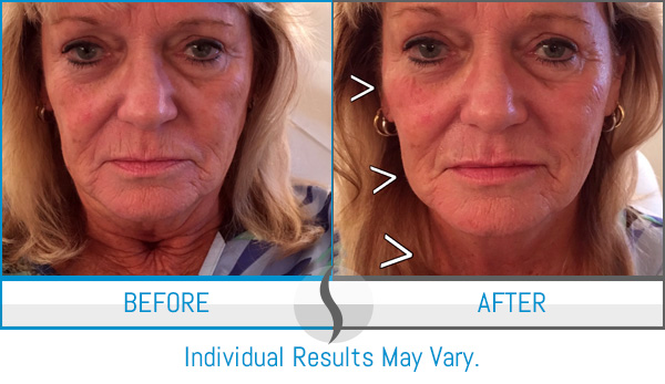Before & After - Spa Blue Skin Care & Laser Center Orlando, FL Before & After - Spa Blue Skin Care & Laser Center Orlando, FL