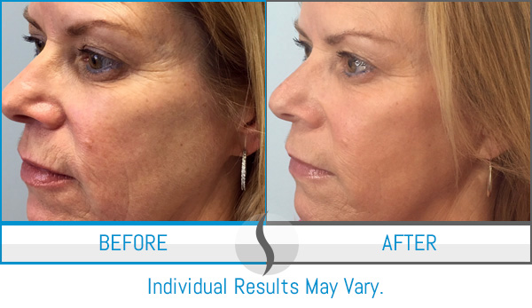 Before & After - Spa Blue Skin Care & Laser Center Orlando, FL Before & After - Spa Blue Skin Care & Laser Center Orlando, FL