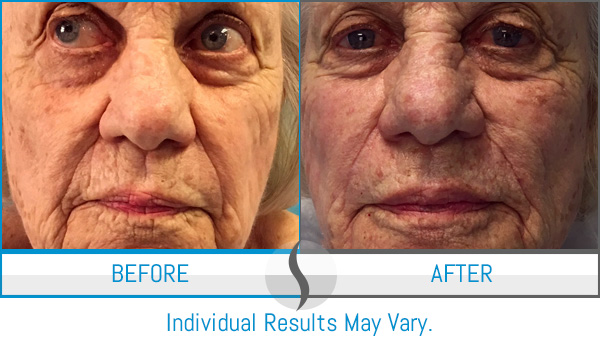 Before & After - Spa Blue Skin Care & Laser Center Orlando, FL Before & After - Spa Blue Skin Care & Laser Center Orlando, FL