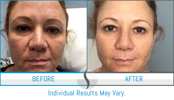 Before & After - Spa Blue Skin Care & Laser Center Orlando, FL Before & After - Spa Blue Skin Care & Laser Center Orlando, FL