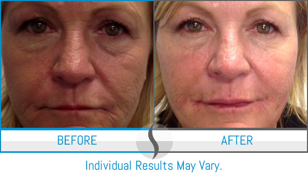 Before & After - Spa Blue Skin Care & Laser Center Orlando, FL Before & After - Spa Blue Skin Care & Laser Center Orlando, FL
