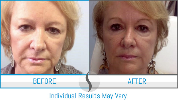 Before & After - Spa Blue Skin Care & Laser Center Orlando, FL Before & After - Spa Blue Skin Care & Laser Center Orlando, FL