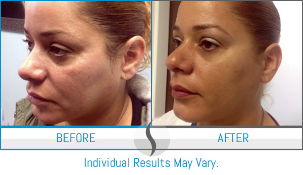 Before & After - Spa Blue Skin Care & Laser Center Orlando, FL Before & After - Spa Blue Skin Care & Laser Center Orlando, FL
