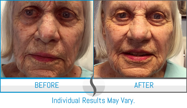 Before & After - Spa Blue Skin Care & Laser Center Orlando, FL Before & After - Spa Blue Skin Care & Laser Center Orlando, FL