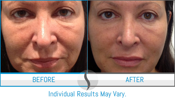 Before & After - Spa Blue Skin Care & Laser Center Orlando, FL Before & After - Spa Blue Skin Care & Laser Center Orlando, FL