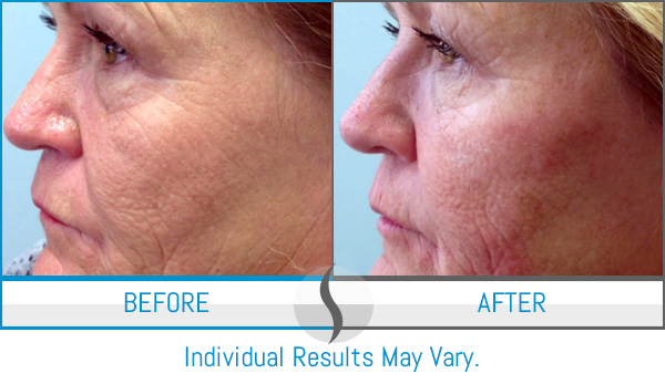 Before & After - Spa Blue Skin Care & Laser Center Orlando, FL Before & After - Spa Blue Skin Care & Laser Center Orlando, FL