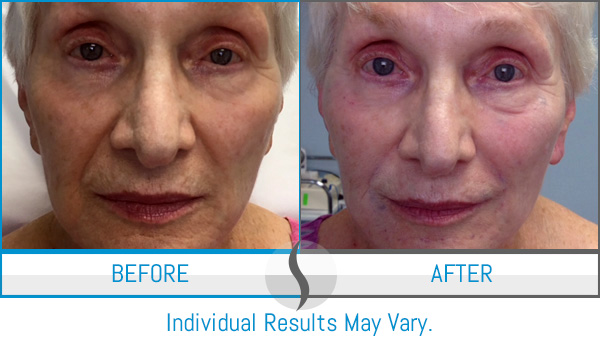 Before & After - Spa Blue Skin Care & Laser Center Orlando, FL Before & After - Spa Blue Skin Care & Laser Center Orlando, FL