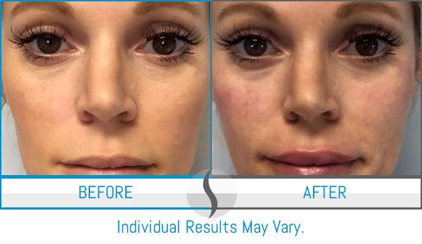 Before & After - Spa Blue Skin Care & Laser Center Orlando, FL Before & After - Spa Blue Skin Care & Laser Center Orlando, FL