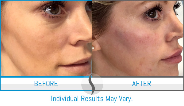 Before & After - Spa Blue Skin Care & Laser Center Orlando, FL Before & After - Spa Blue Skin Care & Laser Center Orlando, FL