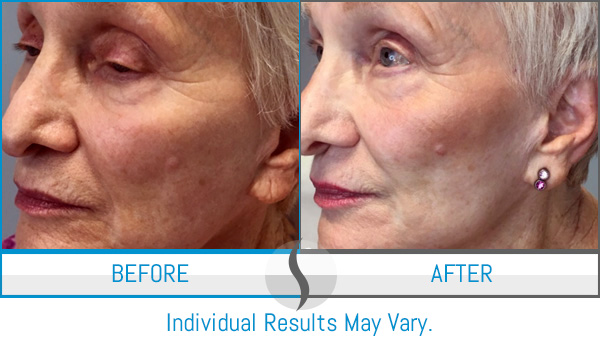 Before & After - Spa Blue Skin Care & Laser Center Orlando, FL Before & After - Spa Blue Skin Care & Laser Center Orlando, FL