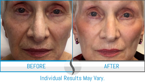 Before & After - Spa Blue Skin Care & Laser Center Orlando, FL Before & After - Spa Blue Skin Care & Laser Center Orlando, FL
