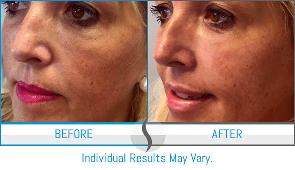 Before & After - Spa Blue Skin Care & Laser Center Orlando, FL Before & After - Spa Blue Skin Care & Laser Center Orlando, FL