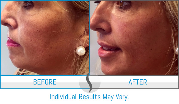 Before & After - Spa Blue Skin Care & Laser Center Orlando, FL Before & After - Spa Blue Skin Care & Laser Center Orlando, FL