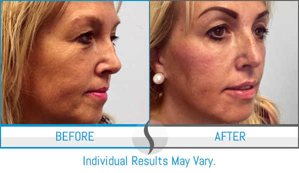 Before & After - Spa Blue Skin Care & Laser Center Orlando, FL Before & After - Spa Blue Skin Care & Laser Center Orlando, FL