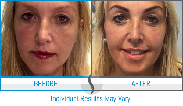 Before & After - Spa Blue Skin Care & Laser Center Orlando, FL Before & After - Spa Blue Skin Care & Laser Center Orlando, FL