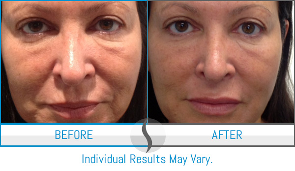 Before & After - Spa Blue Skin Care & Laser Center Orlando, FL Before & After - Spa Blue Skin Care & Laser Center Orlando, FL
