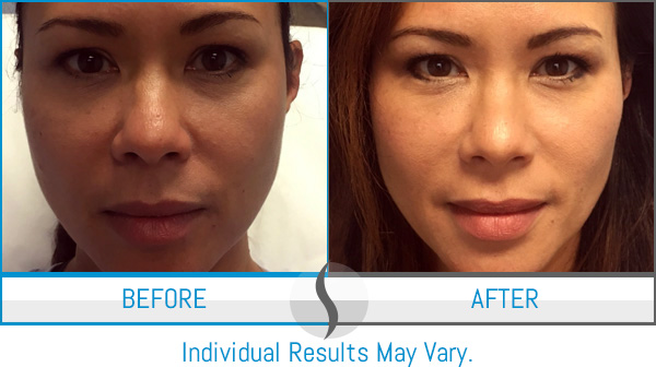 Before & After - Spa Blue Skin Care & Laser Center Orlando, FL Before & After - Spa Blue Skin Care & Laser Center Orlando, FL